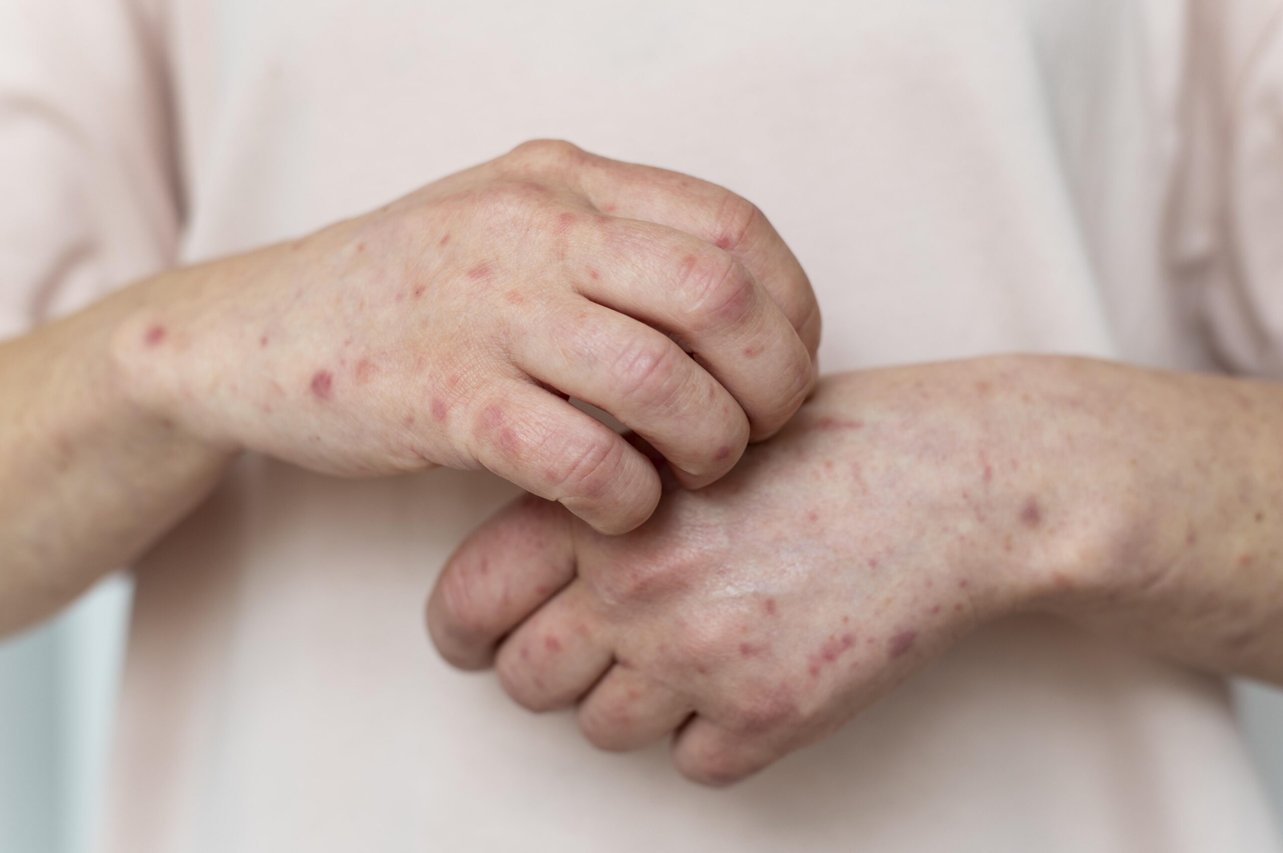 Chickenpox Vaccination